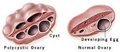 pcos