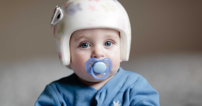 De wetenschap achter een schedelcorrectie bij baby’s