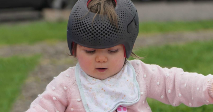 Schedelafwijkingen bij baby’s wanneer kies je voor een redressiehelm
